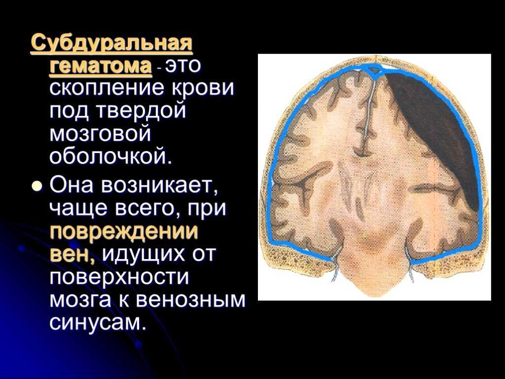 Гематома черепно мозговой травме. Черепно-мозговая гематома субдуральная. Субдуральная гематома головного мозга. Субгалеальная гематома. Субхореальная гематома.