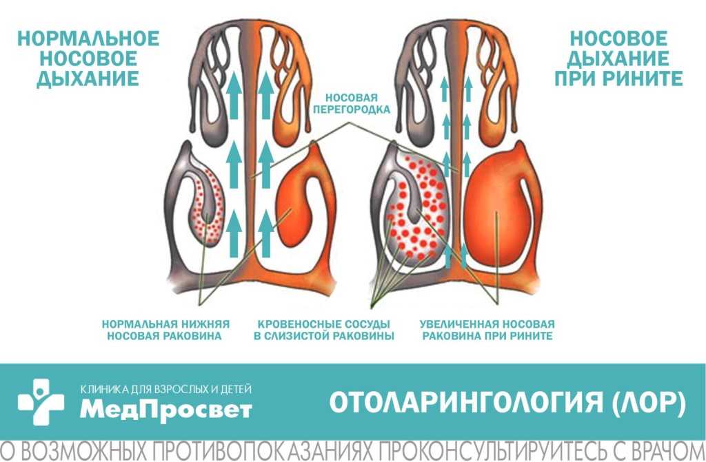 Аллергический ринит: все о заболевании