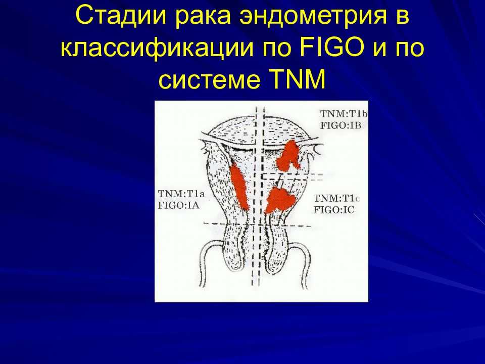 Рак матки. злокачественная опухоль матки