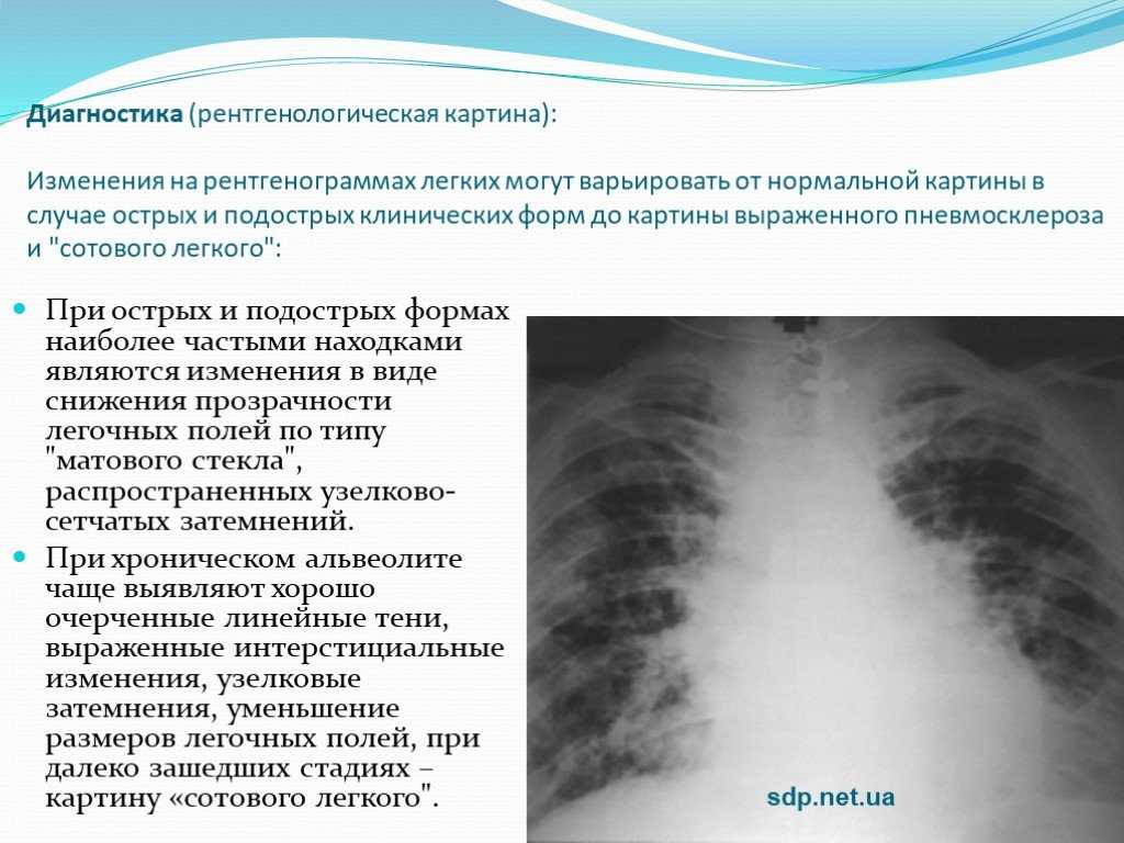 Легочный рисунок с признаками пневмосклероза что