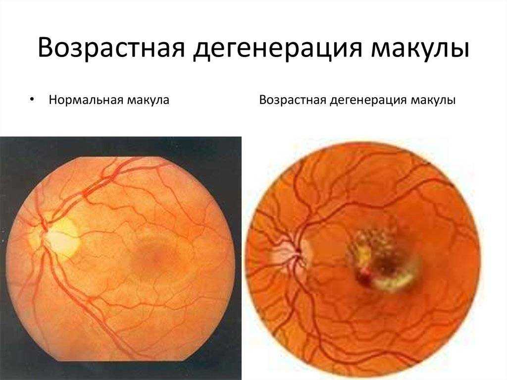 Отслоение сетчатой оболочки: причины, лечение