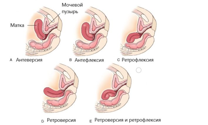 Опасные заблуждения и мифы, касающиеся опущения тазовых органов