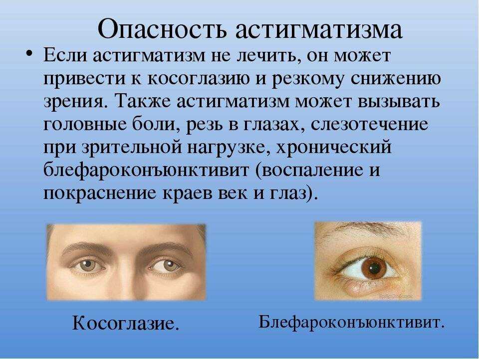 Астигматизм у ребенка в возрасте 1,2,3 года
