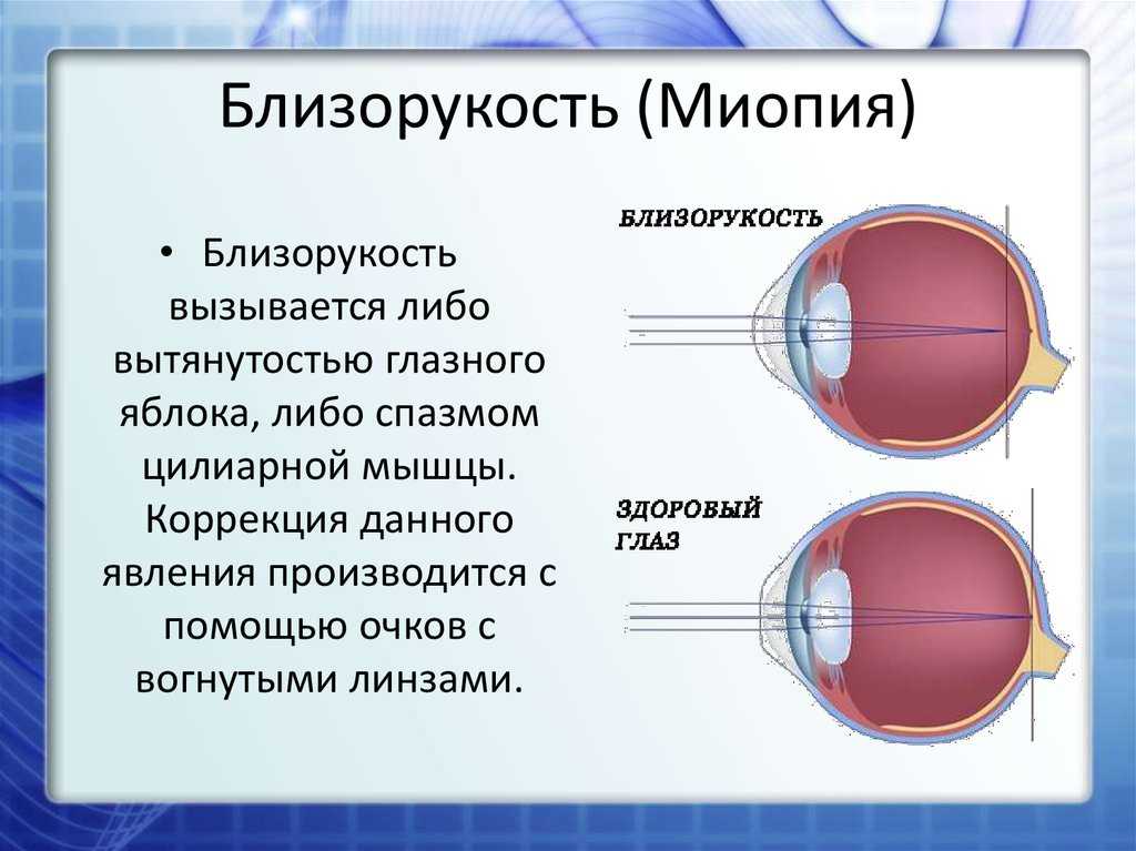 Миопия (близорукость) – причины, профилактика и коррекция