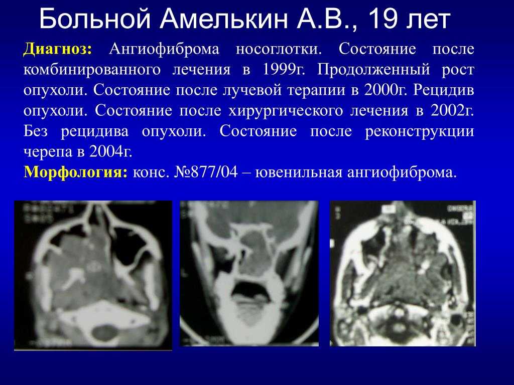 Диагностика ангиофибромы носоглотки на снимках мрт и кт головы
