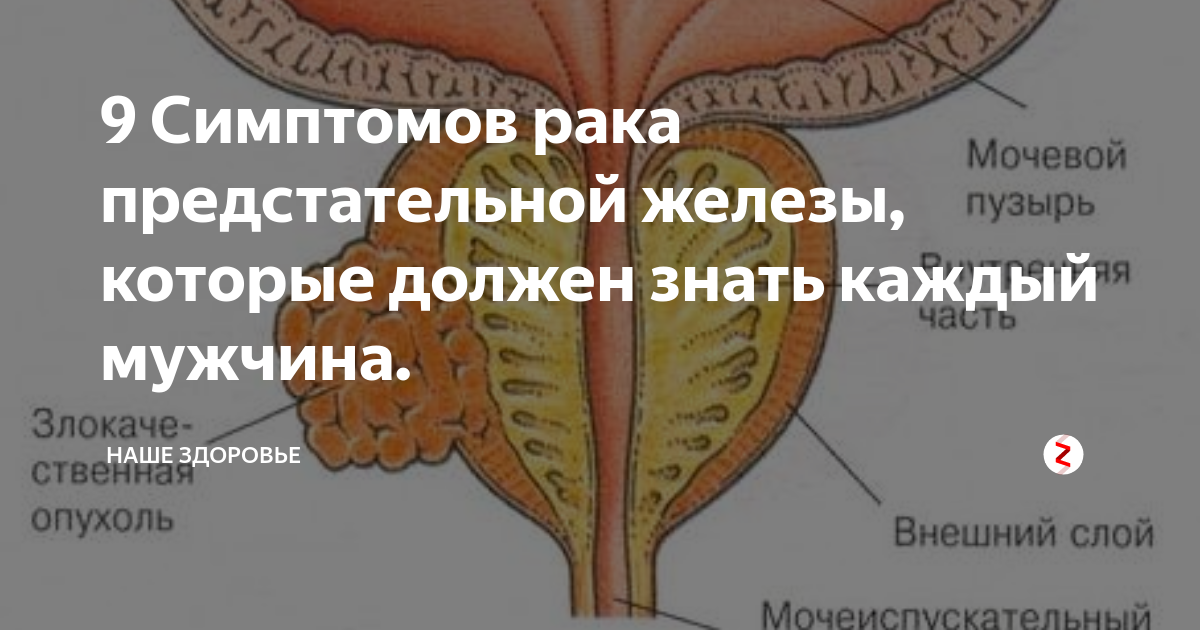 Причины возникновения рака простаты: основные факторы риска