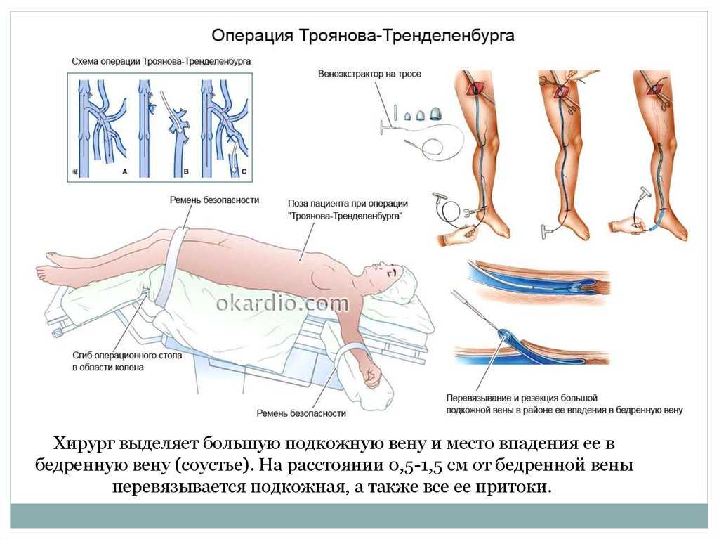 Как определить необходимость операции на варикозные вены?
