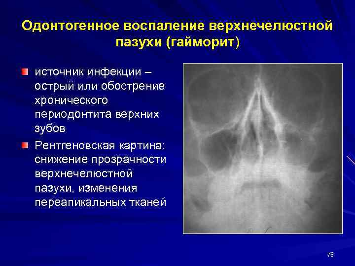 Синусит у детей