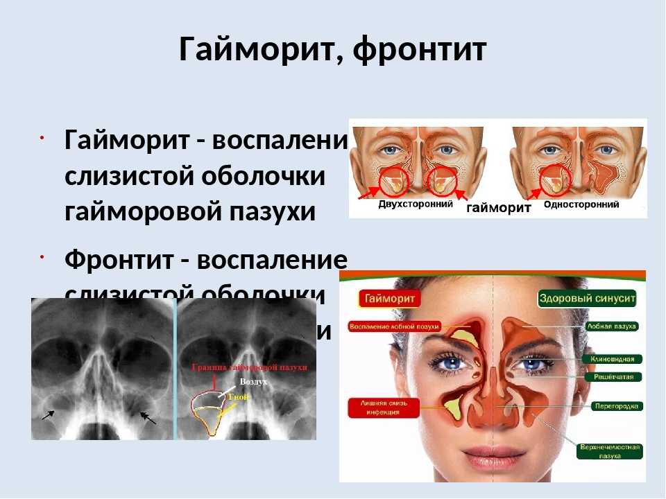 Синусит