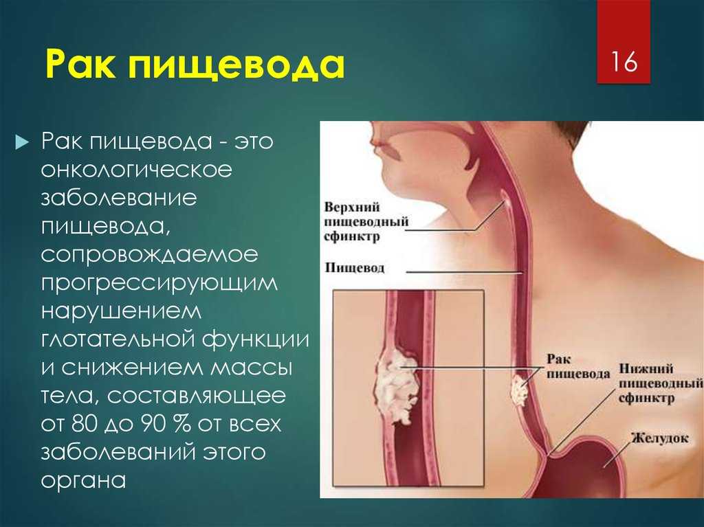 Пищевод барретта (синдром барретта)