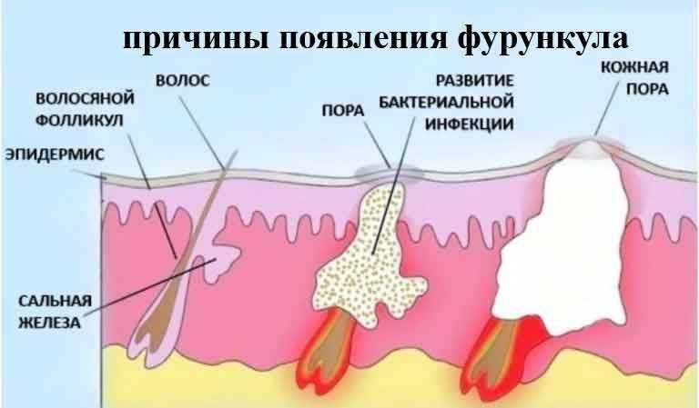 Лечение фурункулеза: причины и профилактика