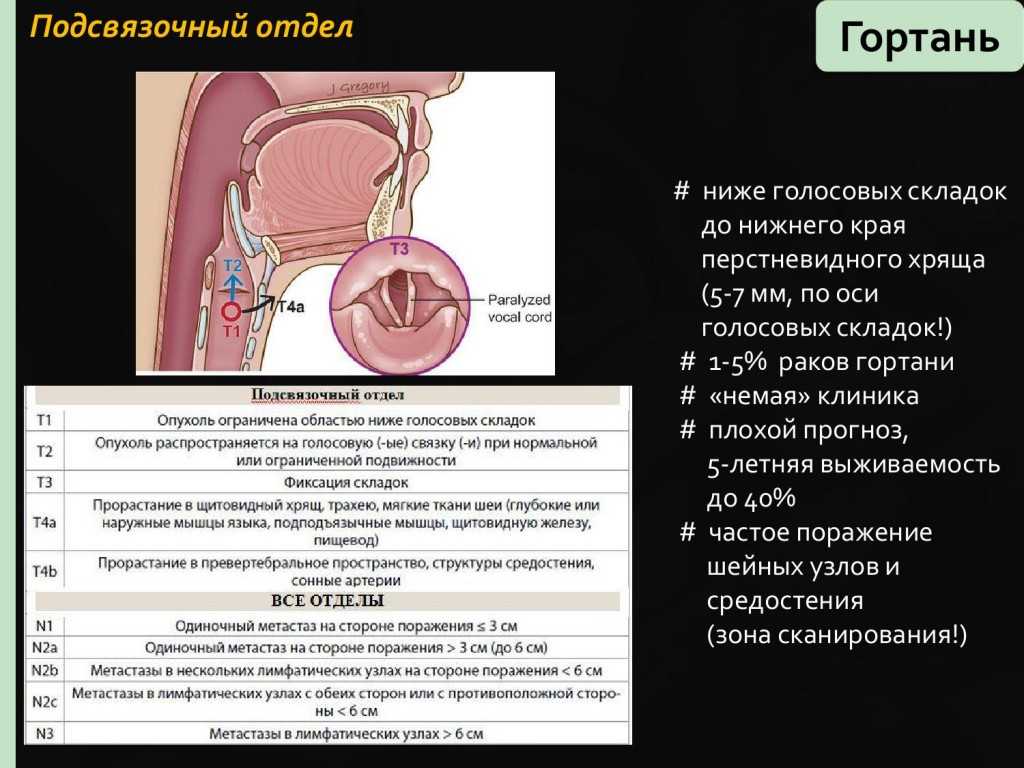 Рак гортани: диагностика и лечение в минске