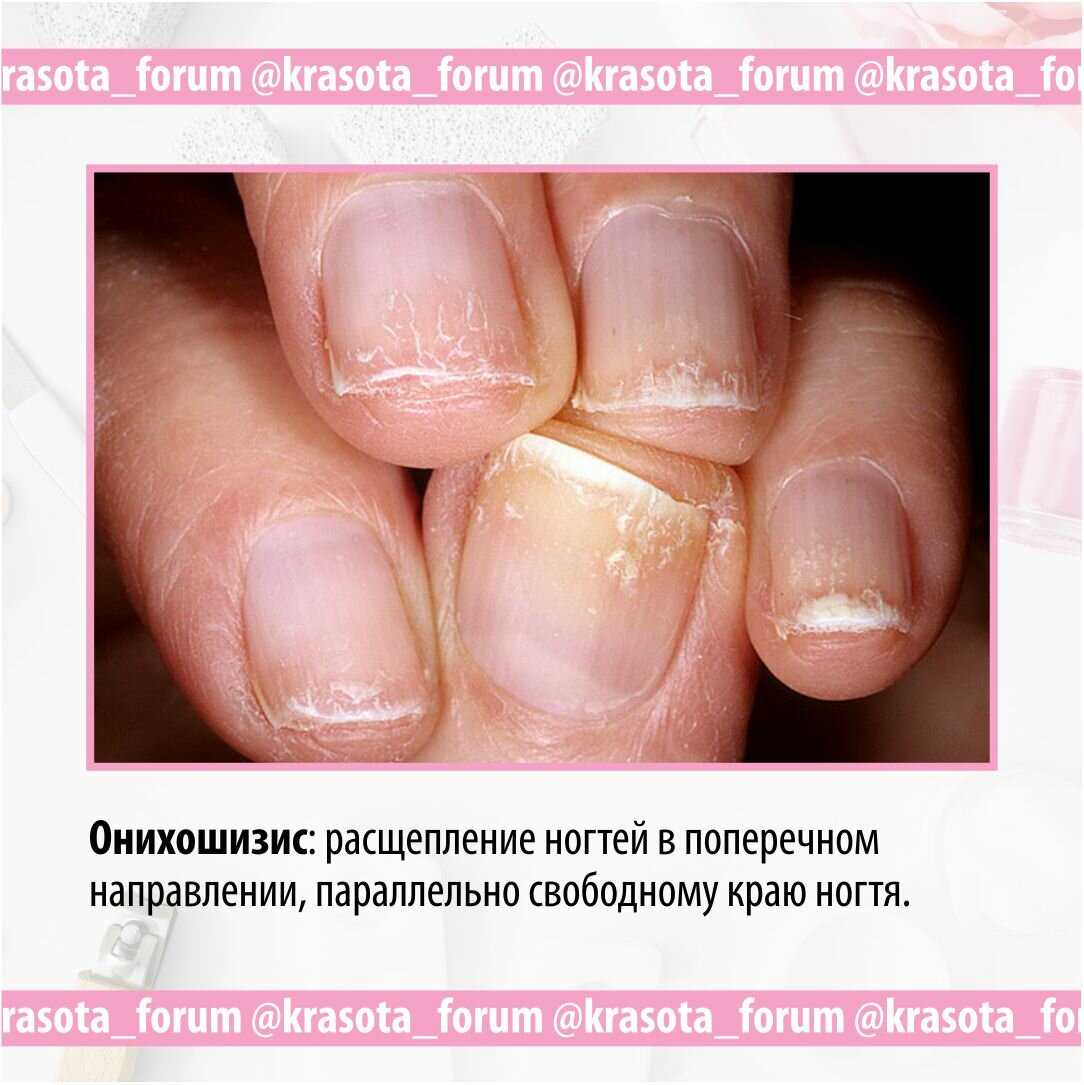 Темное, черное пятно на ногте, под ногтем, фото