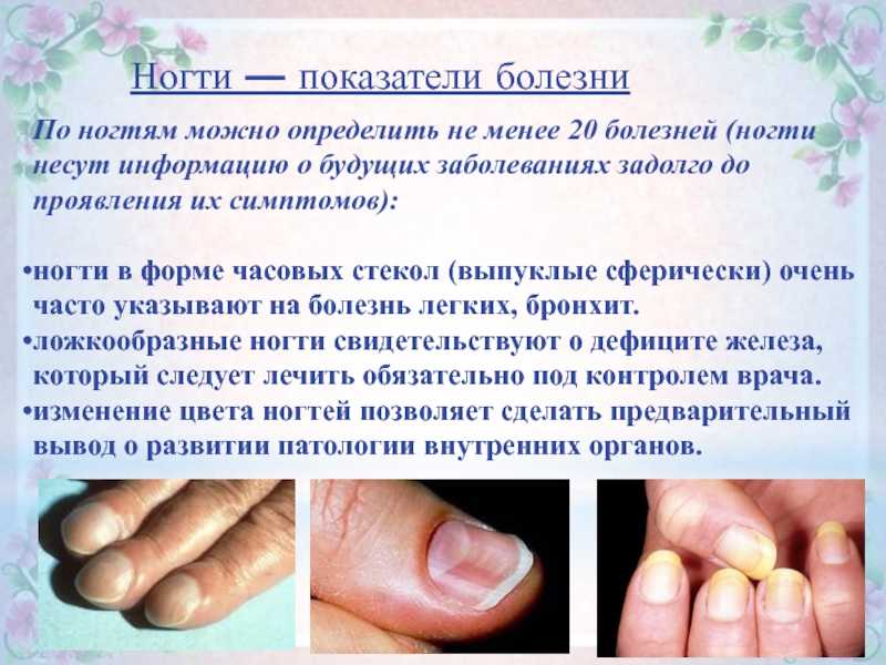 Лечение и профилактика лейконихии, белых пятнен на ногтях — центр подологии podolab