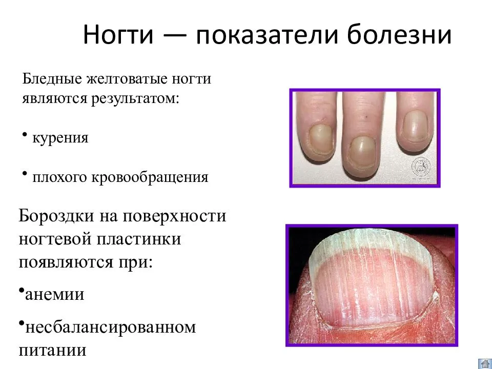 Потемнения на ногтях: причины и как устранить