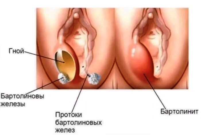 Препараты при варикозе малого таза