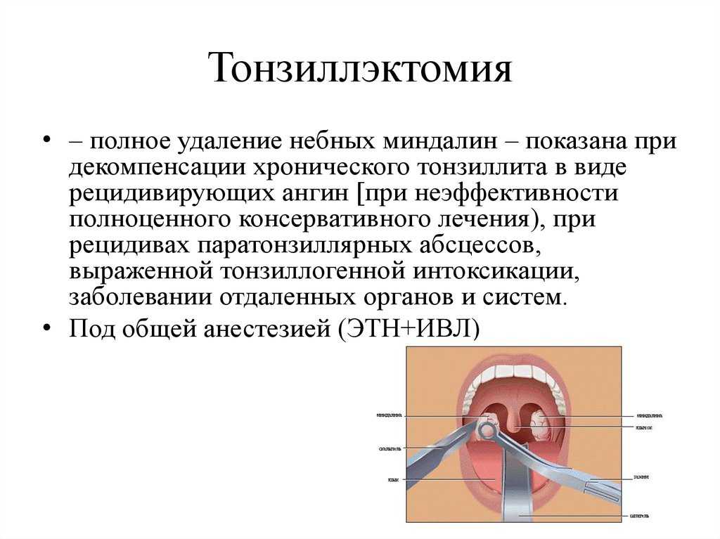 Удаление миндалин лазером | лор клиника "солнце"