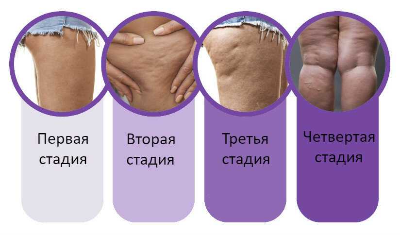 Ошибки при борьбе с целлюлитом