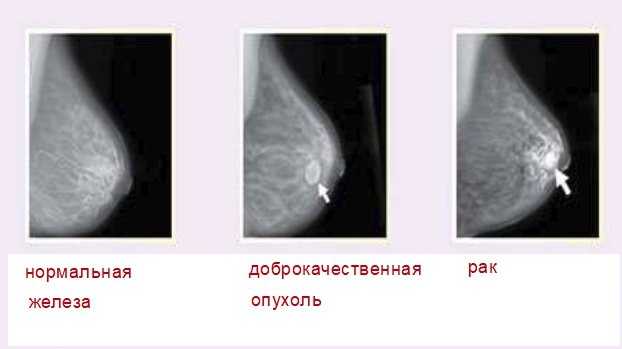 Волосы на сосках у женщин
