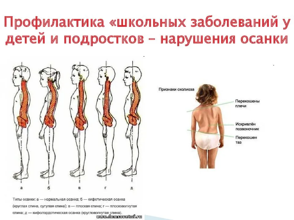 Профилактика плоскостопия у взрослых