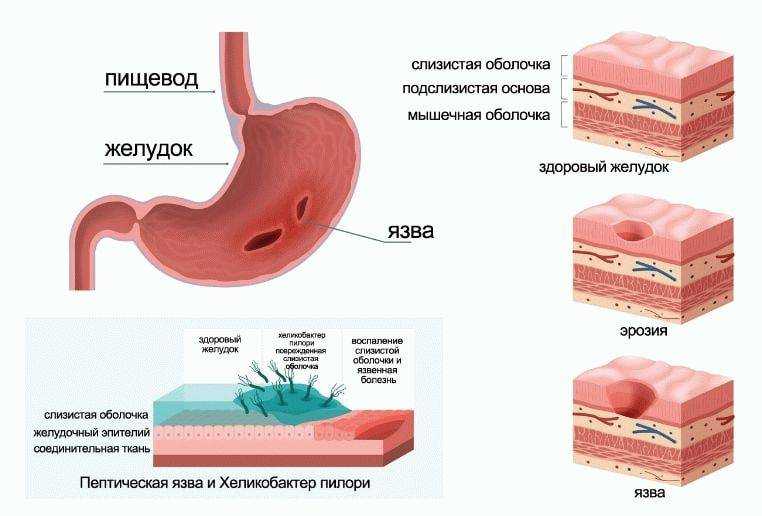 Гастрит: симптомы и лечение – напоправку