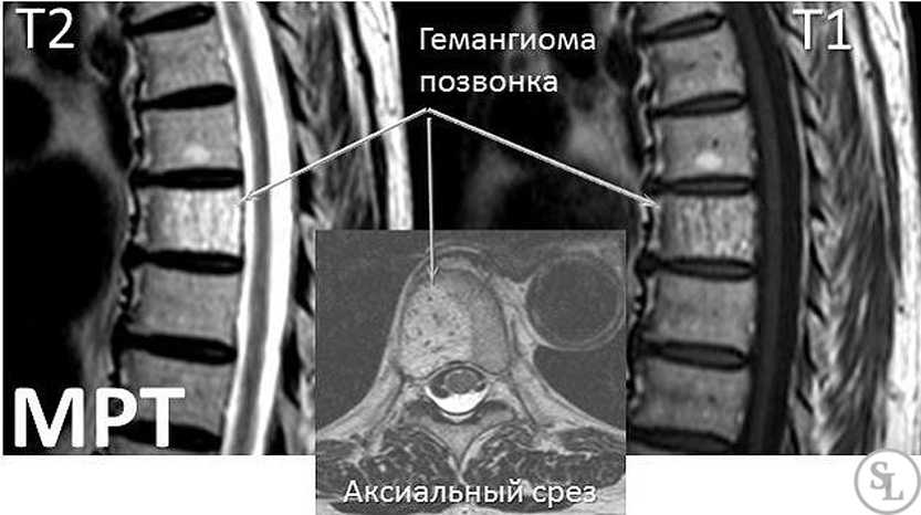 Ангиомы (гемангиомы) тел позвонков. клиничекие проявления, диагностика и лечение доброкачественных опухолей позвоночника