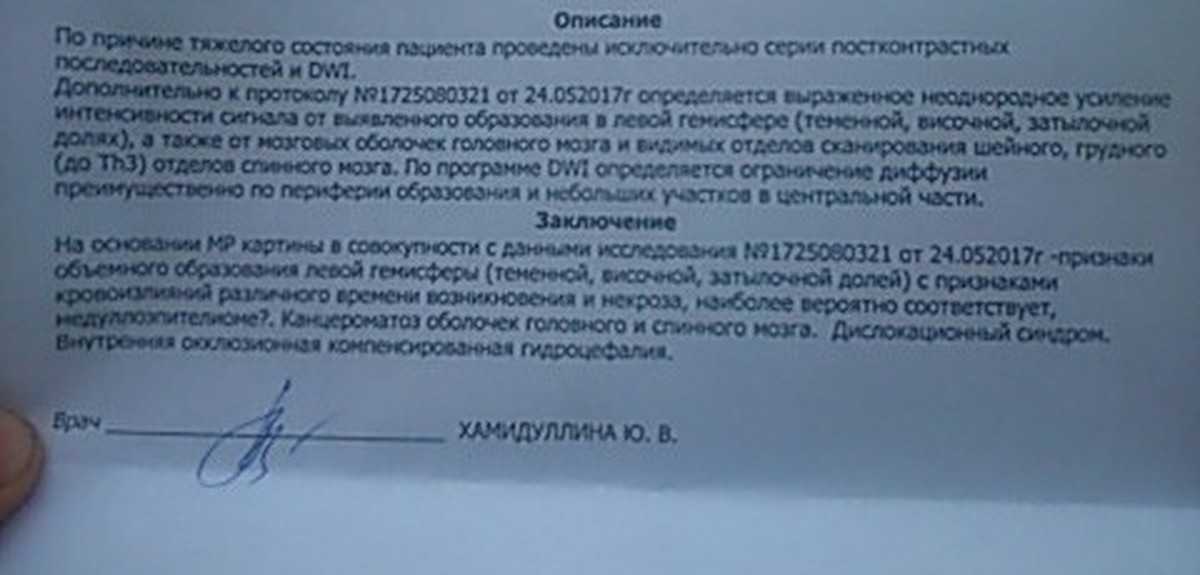 Опухоль мозга: симптомы, стадии, причины заболевания