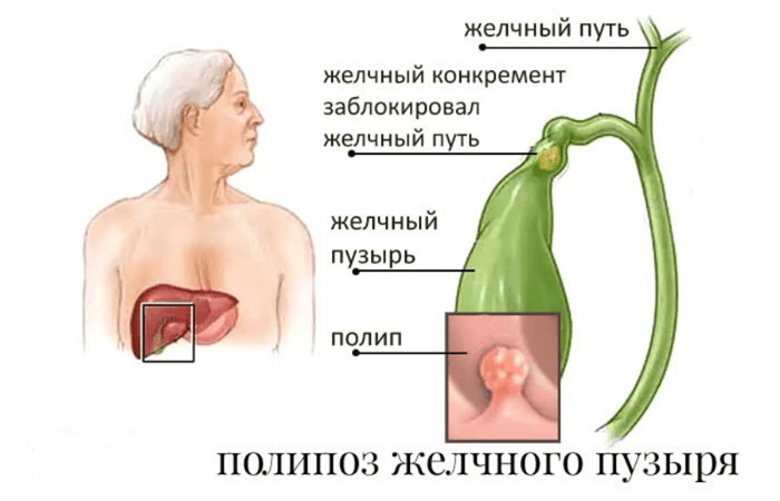 Холецистэктомия — операция по удалению желчного пузыря, порядок проведения и показания | клиники «евроонко»