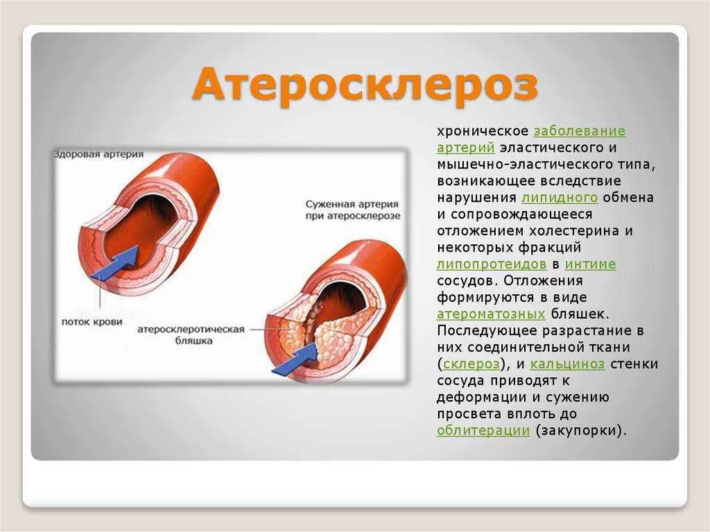 Атеросклероз сосудов