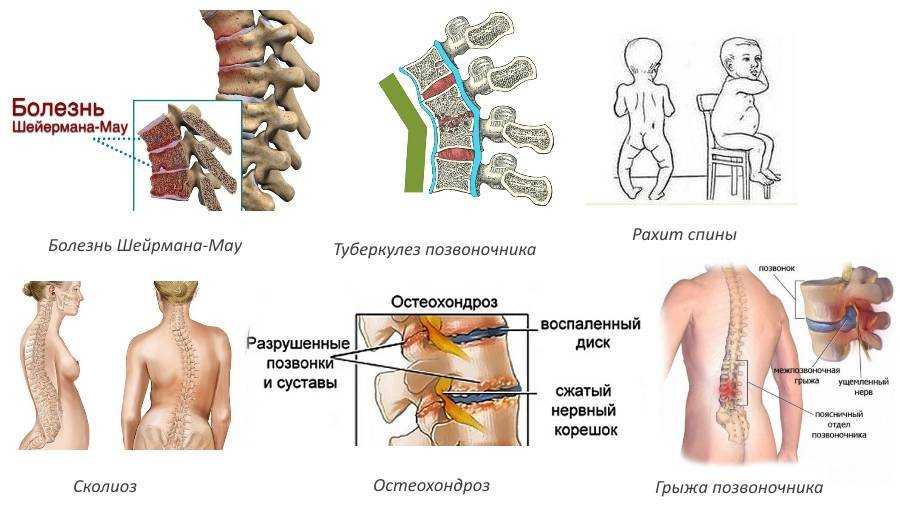 Лечение пояснично-крестцового остеохондроза