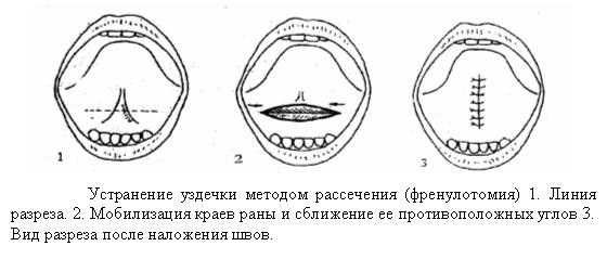Френулотомия: показания, противопоказания, фото до/после