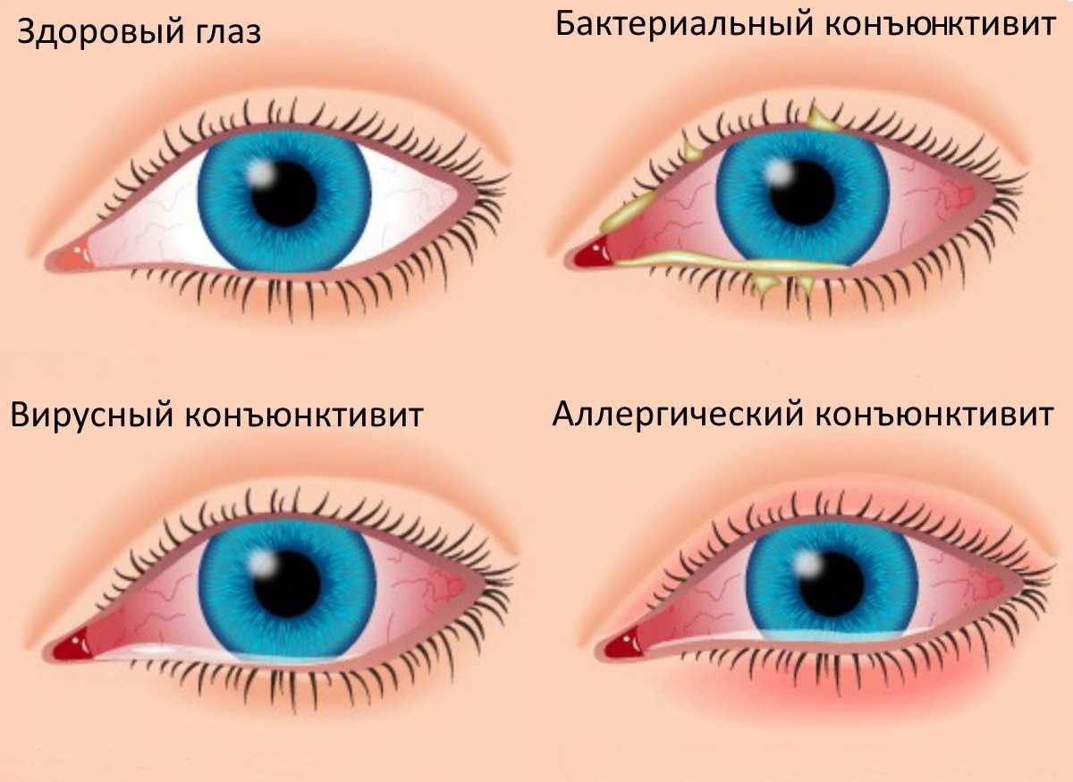 Конъюнктивит у детей: диагностика и современное лечения заболевания. — into-sana