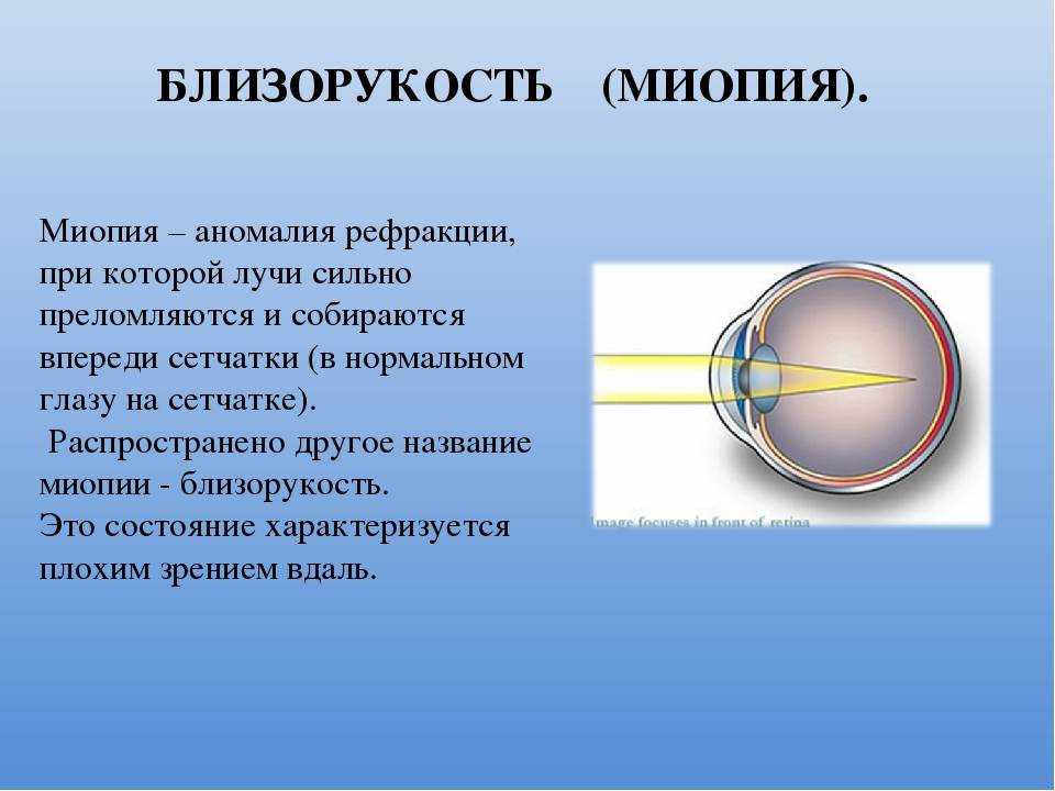 Почему возникает близорукость — 21 причина