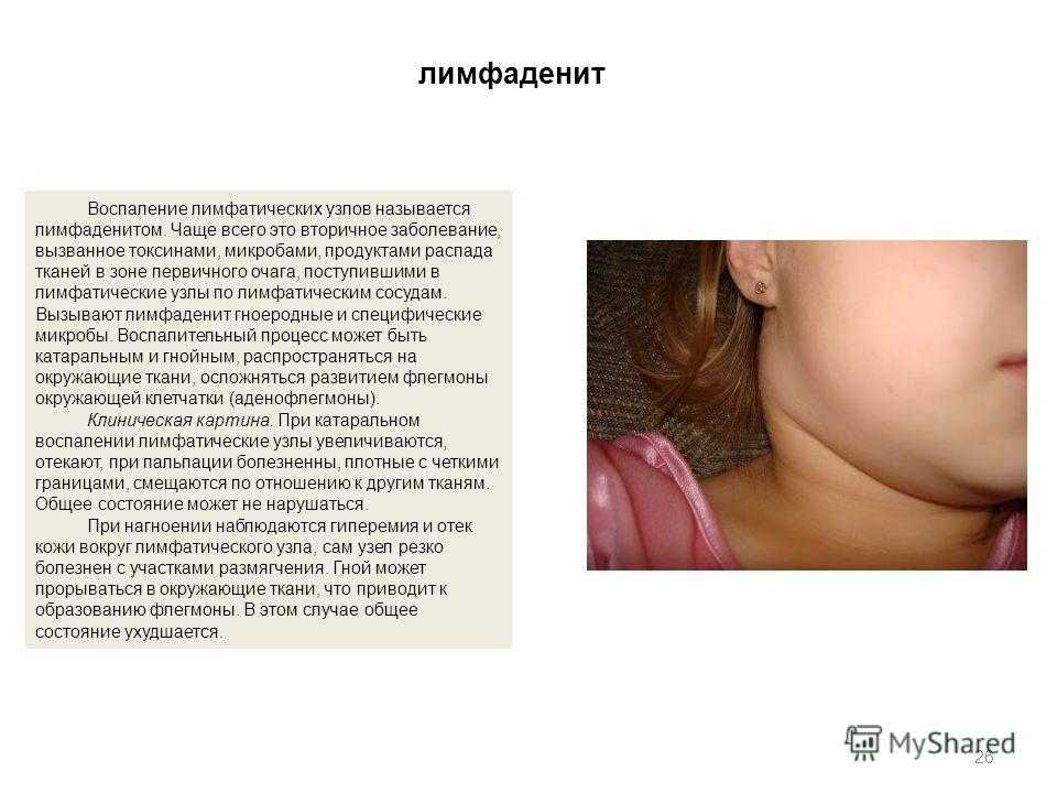 Лимфаденит у детей - признаки, причины, симптомы, лечение и профилактика - idoctor.kz