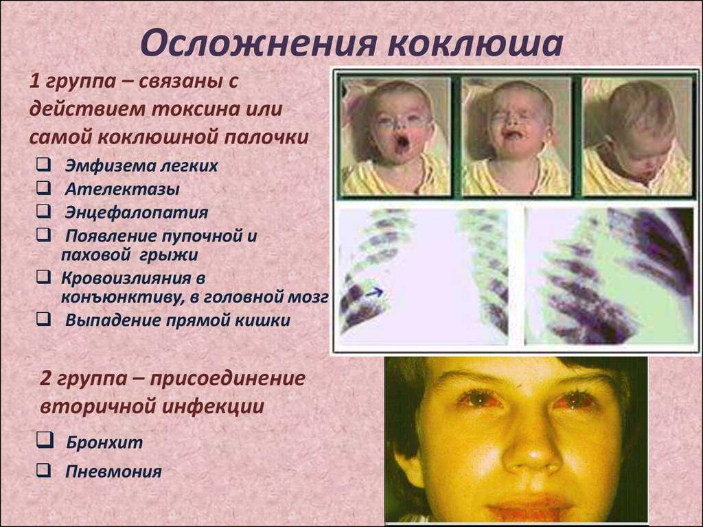 Осенний коклюш: этапы, лечение, профилактика