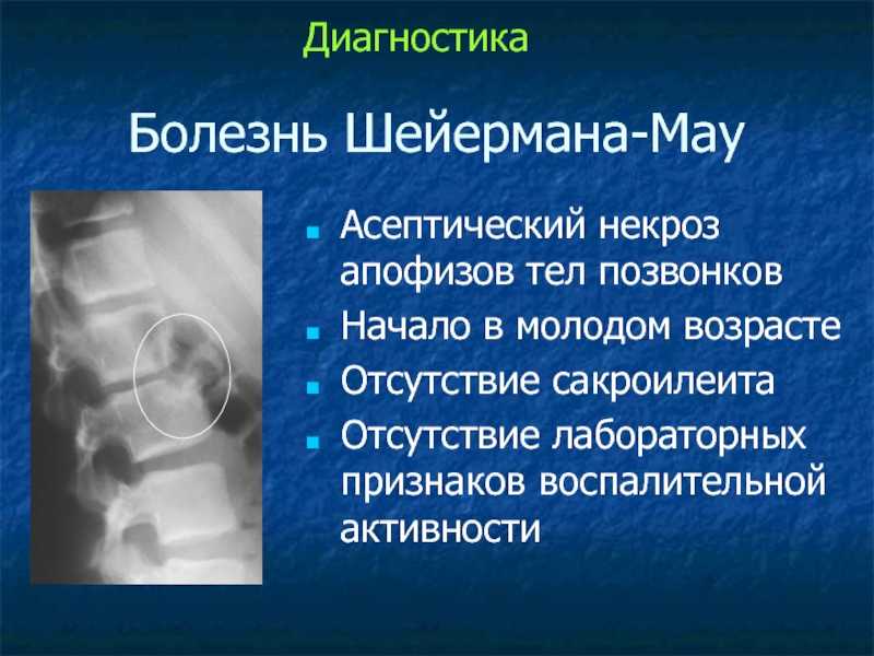 Болезнь мау. Асептический некроз тел позвонков. Асептический некроз позвонка рентген.