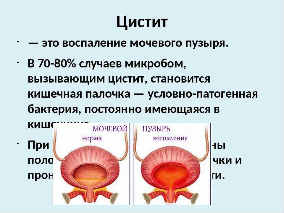 Цистит у женщин, симптомы и лечение