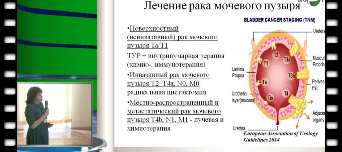 Рак мочевого пузыря: причины, симптомы, диагностика, лечение - клиника target