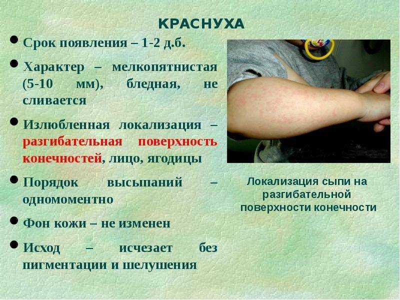 Краснуха у детей. признаки и симптомы краснухи у детей
