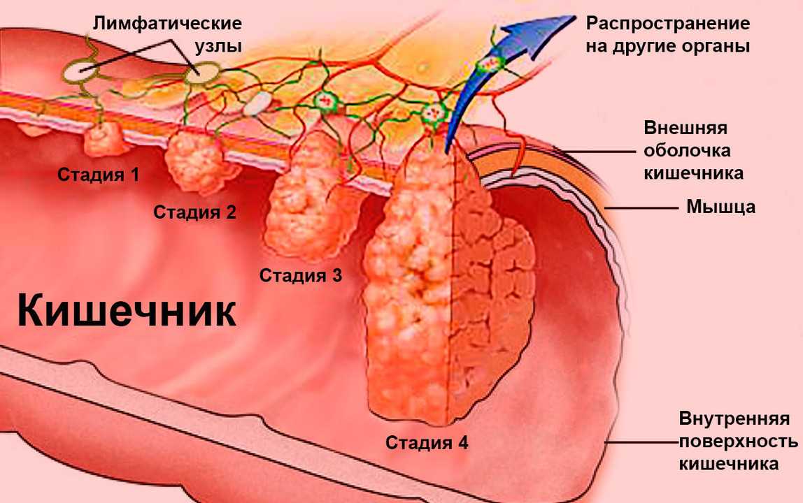 Рак прямой кишки рисунок