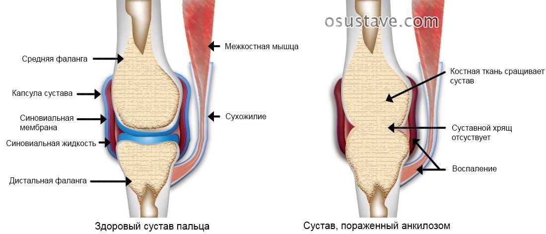 Как определить некроз головки бедра? ortoped-klinik.com