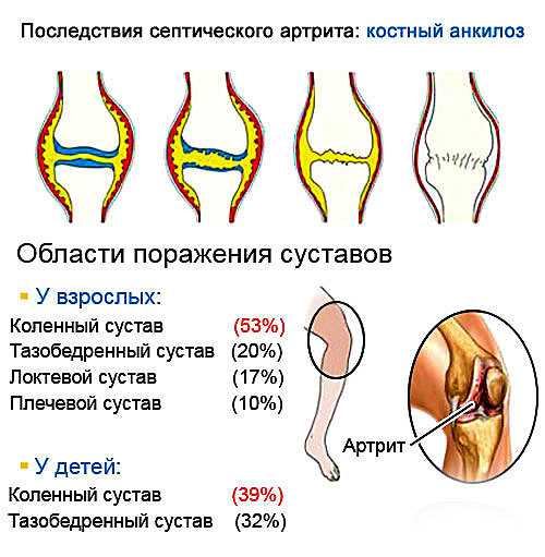 Вывихи бедренной кости в тазобедренном суставе (в т.ч. вывихи головки эндопротеза, эндопротезирование тазобедренного сустава, перипротезные переломы) – симптомы травмы, первая помощь и лечение, реабилитация – отделение травматологии нкц №2 (цкб ран)