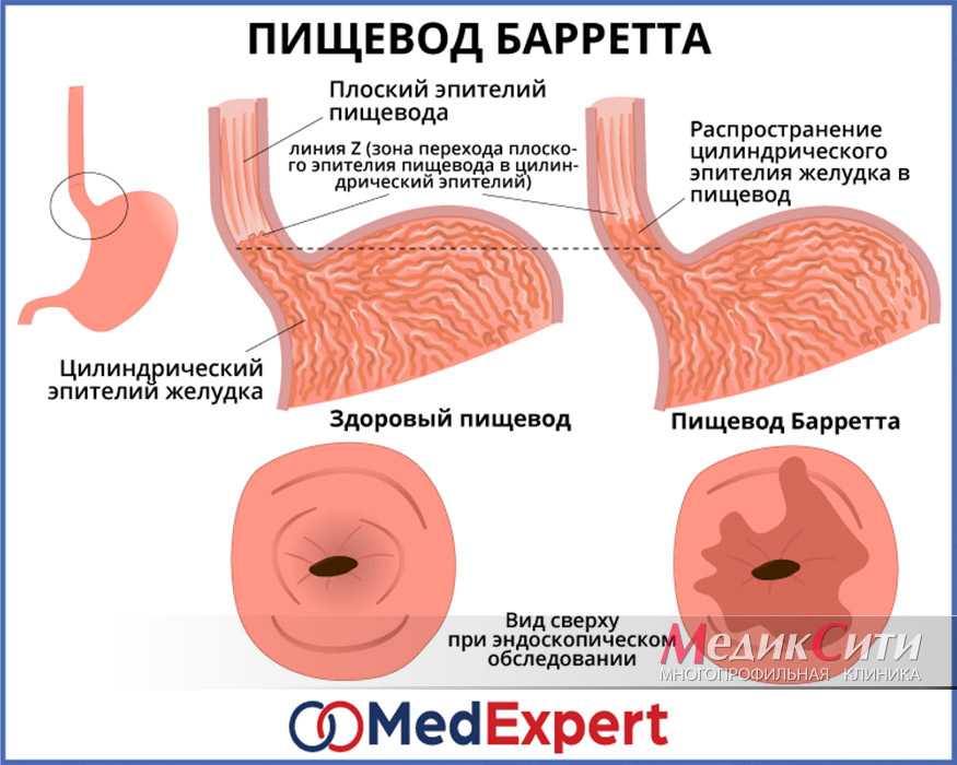 Пищевод барретта — surgery-first.ru