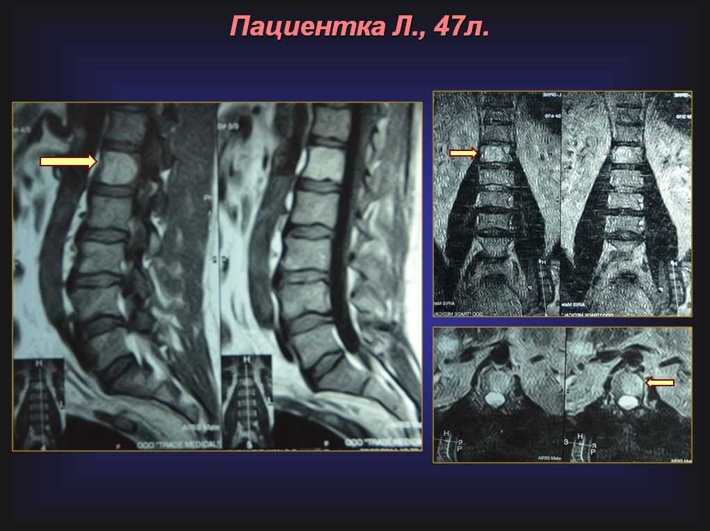 Гемангиома позвоночника что это. Th6 позвонка гемангиома. Гемангиома l2 позвоночника поясничного отдела. Гемангиома позвоночника th10. Гемангиомы l1 l2 позвонков.