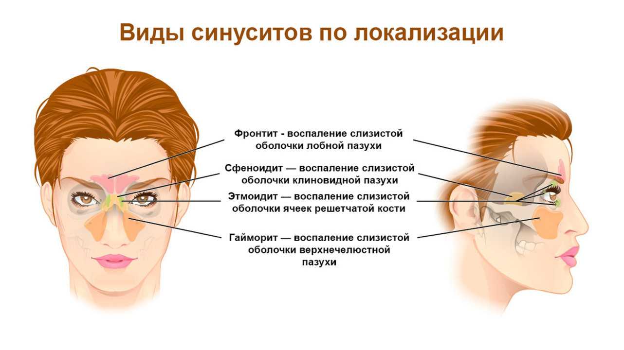 Верхнечелюстной синусит: причины, симптомы, лечение