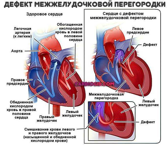 Хроническая ревматическая болезнь сердца