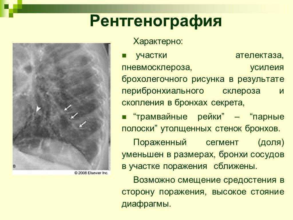 Легочный рисунок с признаками пневмосклероза что это значит у женщин