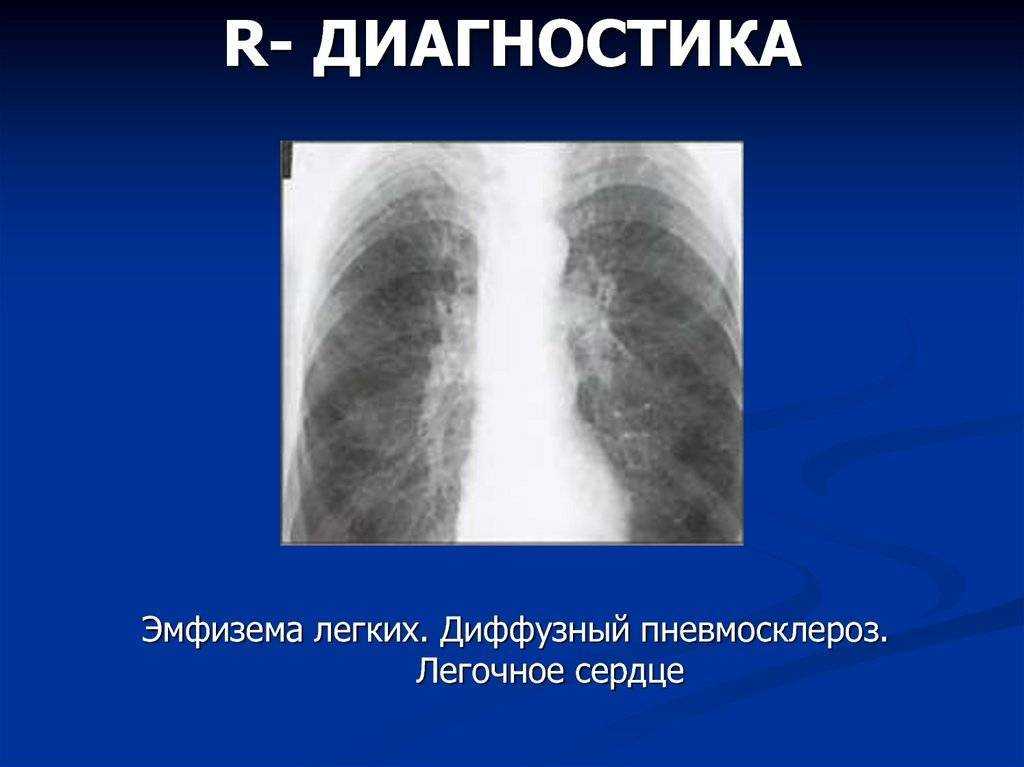 Легочный рисунок с признаками пневмосклероза что