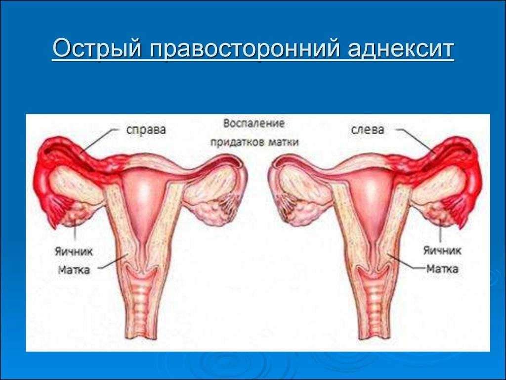 Лечение хронического воспаления придатков