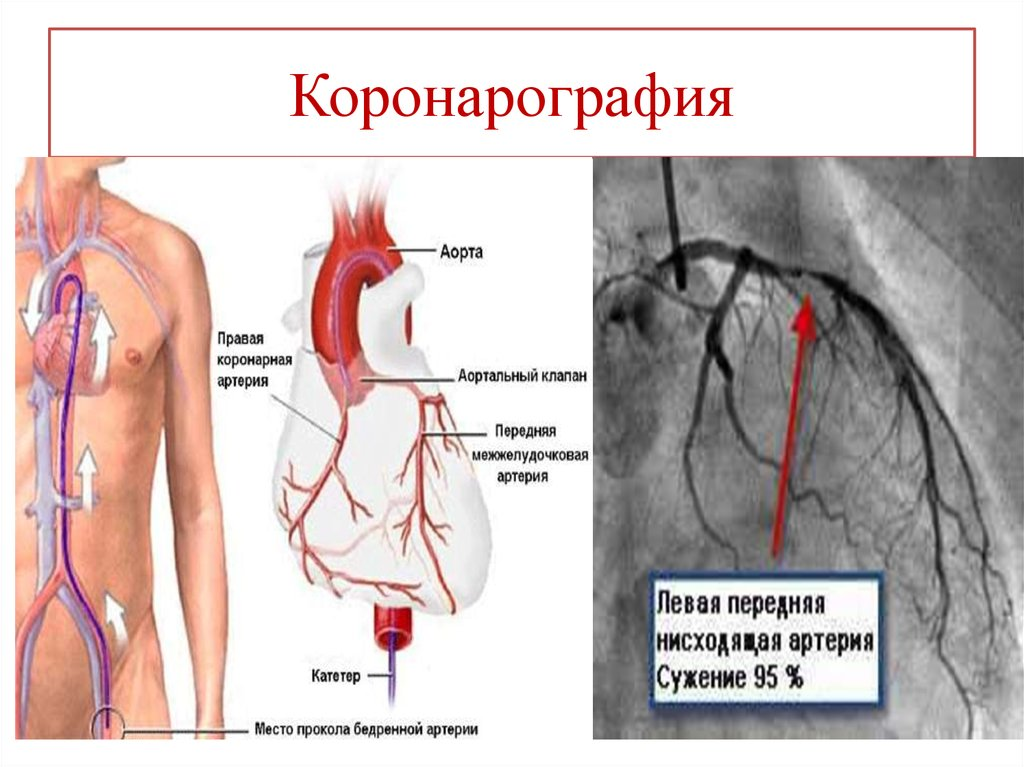 Опасна ли коронарография? риски, возможне последствия и